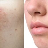 Asian young with pimple, acne, scar on skin, facial problem.
