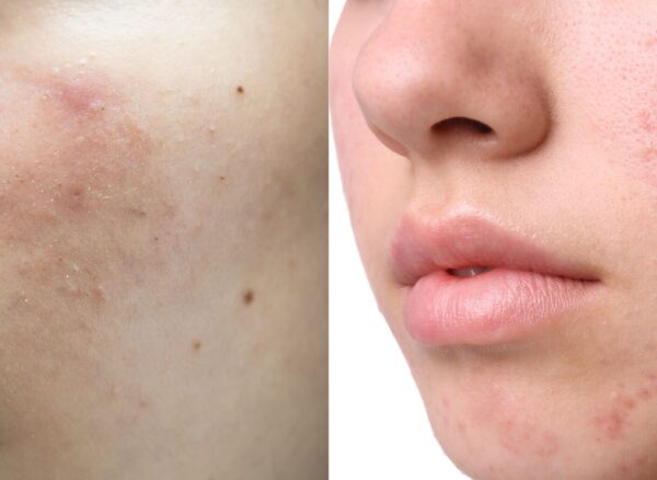 Asian young with pimple, acne, scar on skin, facial problem. Asian young with pimple, acne, scar on skin, facial problem.