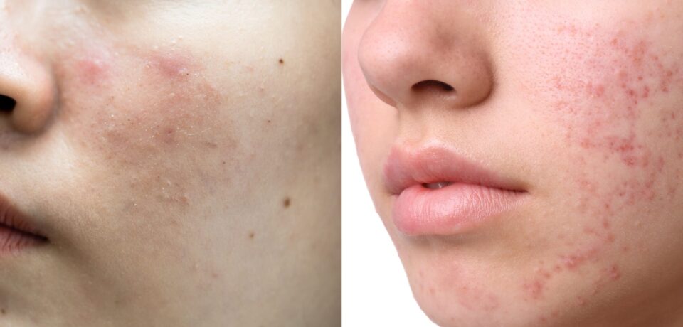 Asian young with pimple, acne, scar on skin, facial problem.